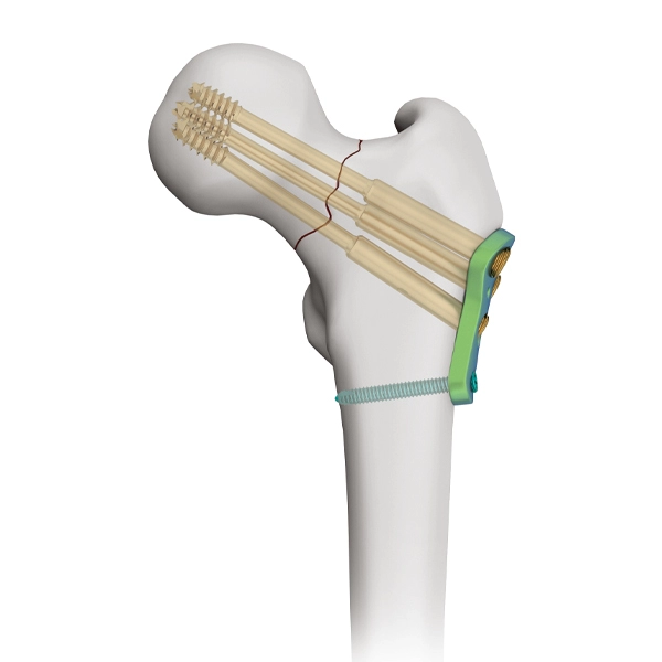 Proximale femorale Verriegelungsplatte für kanülierte 7,3-mm-Schraube